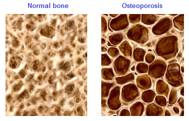 normal bone and osteoporosis