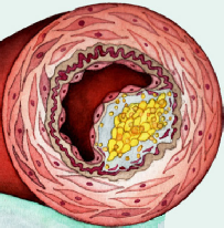 The atherosclerotic lesion